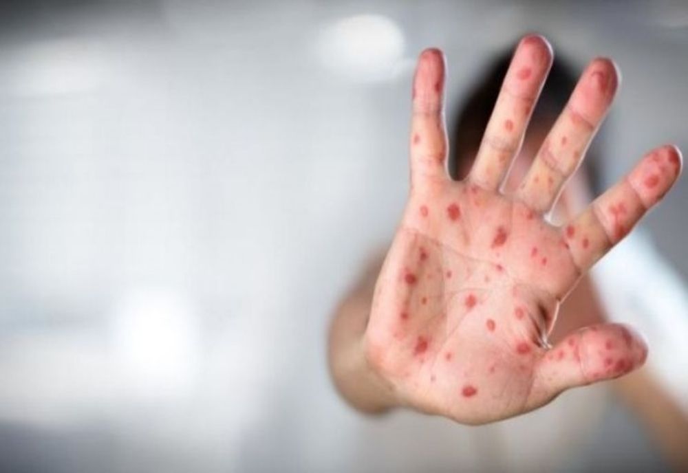 România riscă o epidemie de rujeolă! Efectele devastatoare ale bolii
